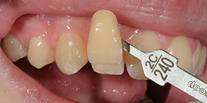 bleaching vorher bleaching vorher